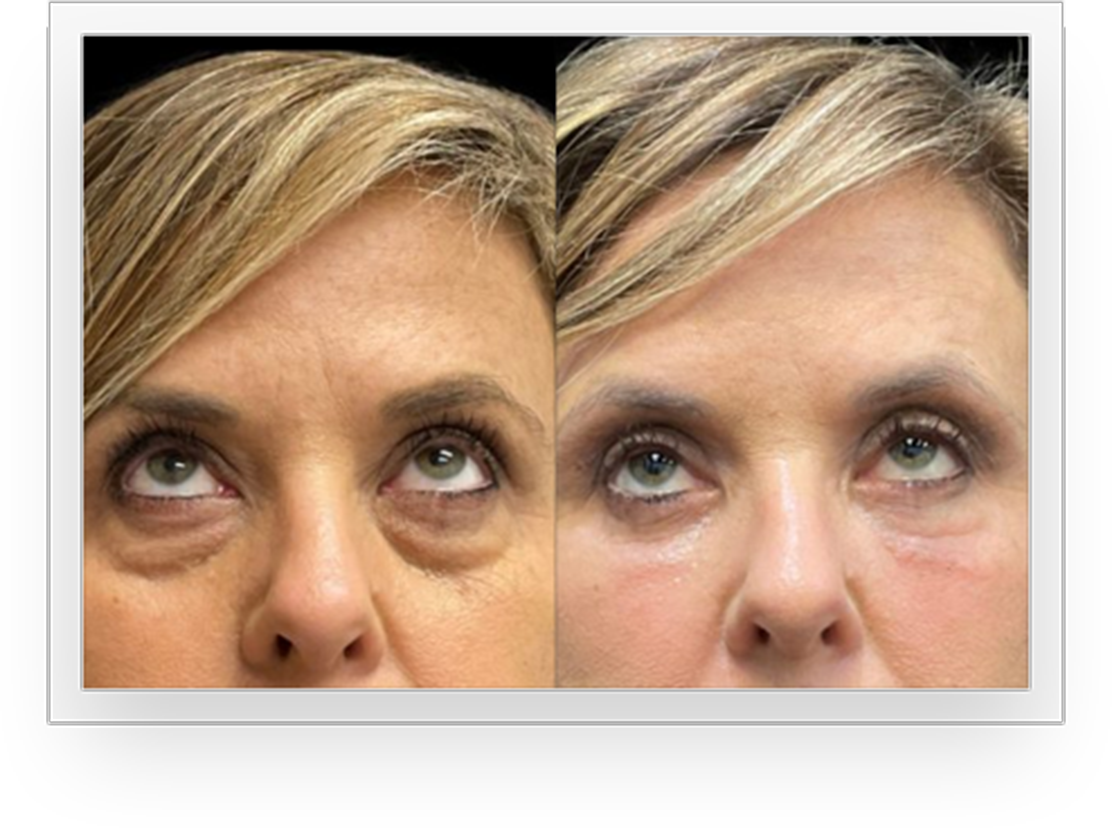 EyesBA1@1,5x