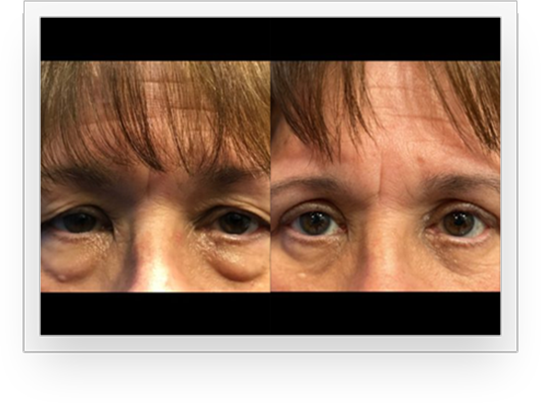 EyesBA2@1,5x