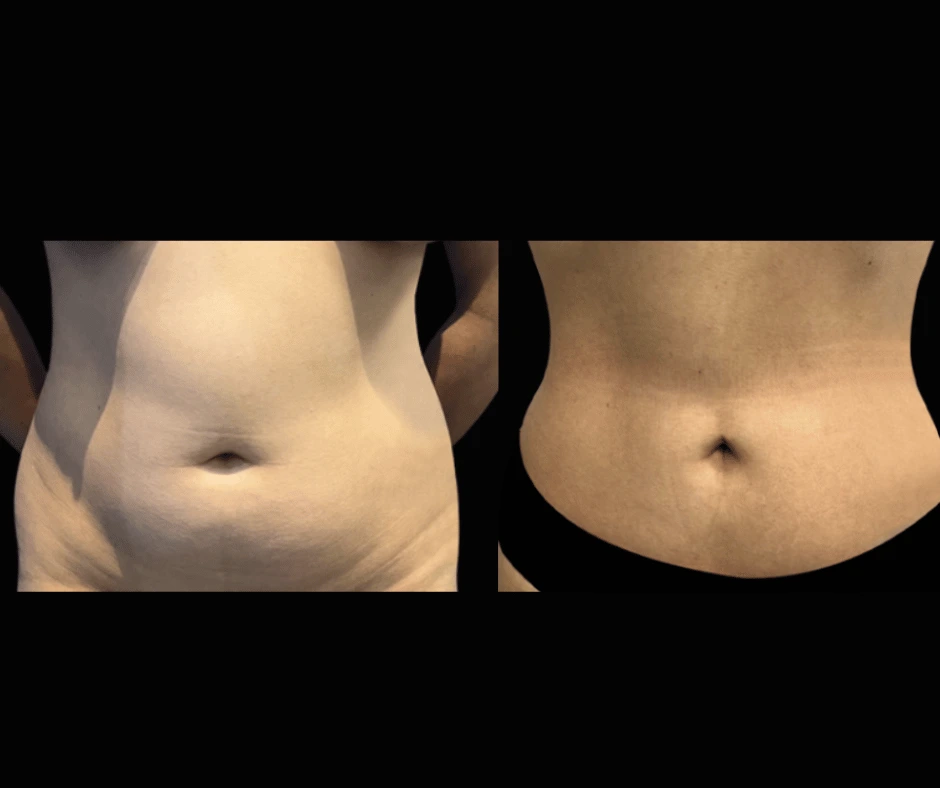 Lipo-Results-Dr.-Greenberg-2.png