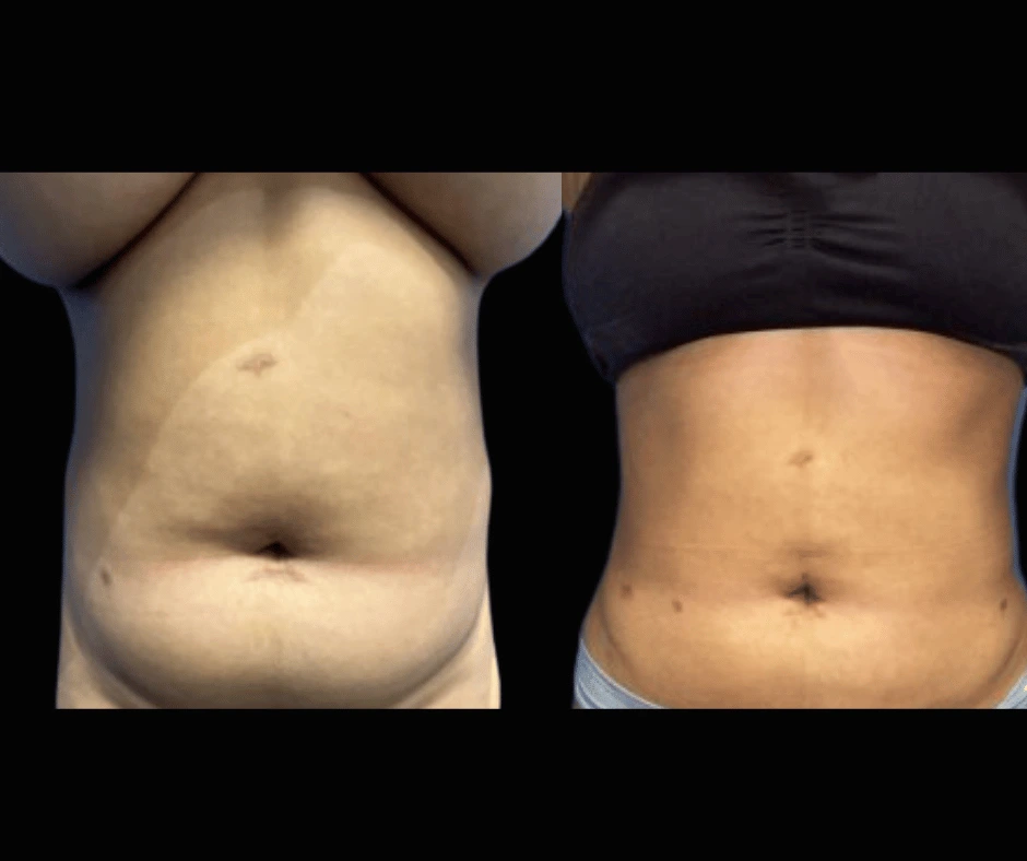Lipo-Results-Dr.-Greenberg-3.png