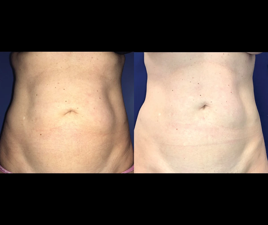 Lipo-Results-Dr2